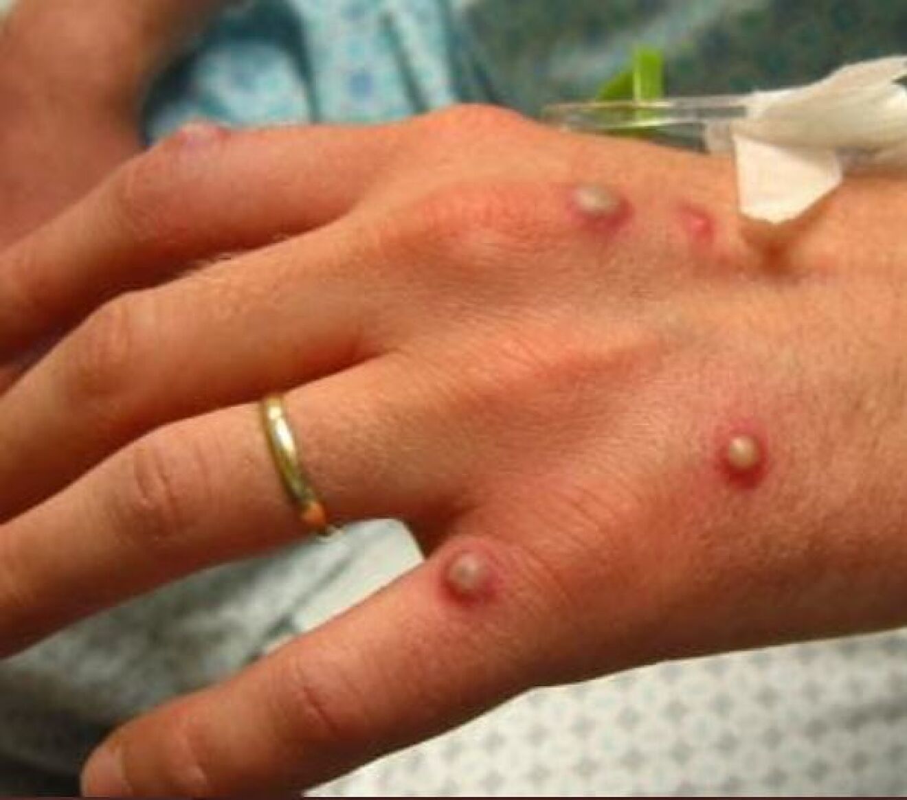 Monkeypox appeared in many countries - Photo 1.