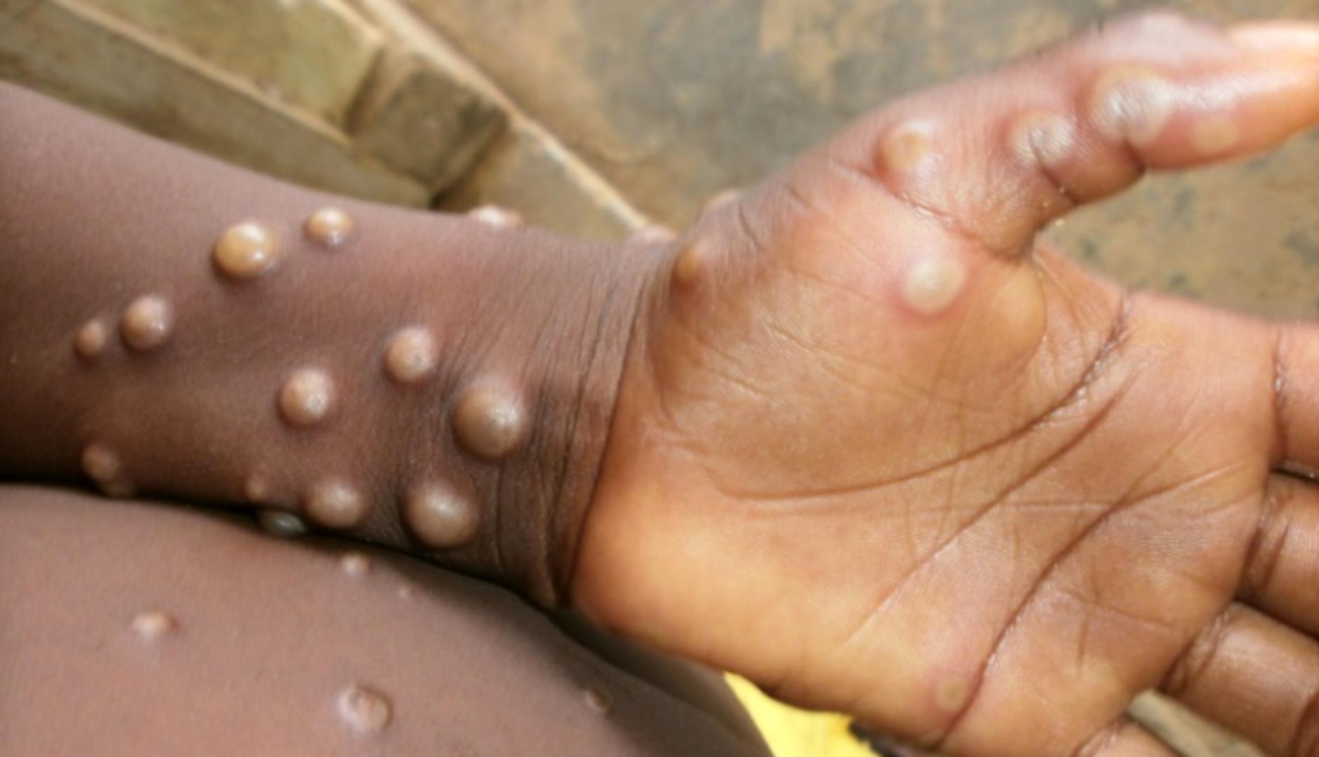 There have been 10 deaths from monkeypox in endemic areas - Photo 1.
