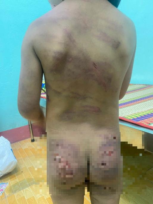 Trẻ bị cha dượng và mẹ đánh: Chủ tịch UBND tỉnh Bình Phước ký công văn khẩn - Ảnh 1.