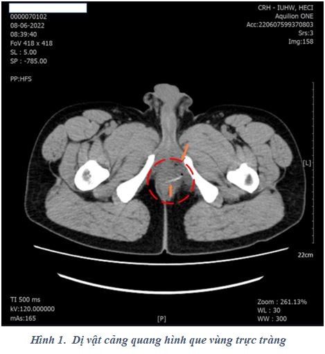 Hình ảnh Mẫu Mô Phỏng Xương Sườn PNG  Lồng Xương Sườn Xương Bone PNG  miễn phí tải tập tin PSDComment và Vector