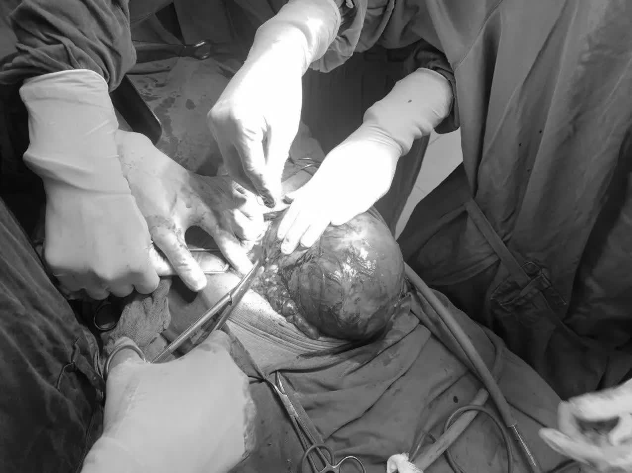 Tưởng béo bụng do uống bia hóa ra khối u khổng lồ - Ảnh 1. Tưởng béo bụng do uống bia hóa ra khối u khổng lồ - Ảnh 1.