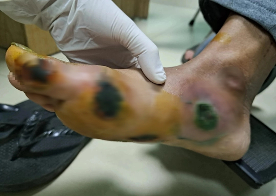 Bệnh nhân đái tháo đường loét bàn chân do thói quen thường gặp - Ảnh 1.