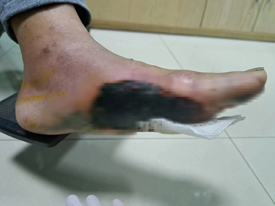 Bệnh nhân đái tháo đường loét bàn chân do thói quen thường gặp - Ảnh 3.