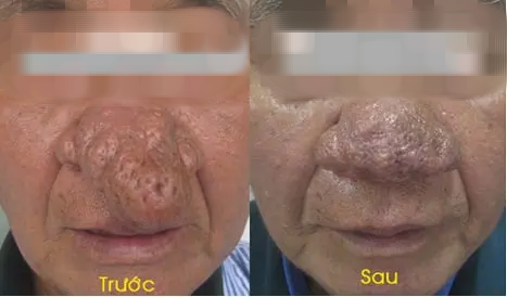 Người đàn ông bị mũi sư tử- Ảnh 2. Người đàn ông bị mũi sư tử- Ảnh 2.
