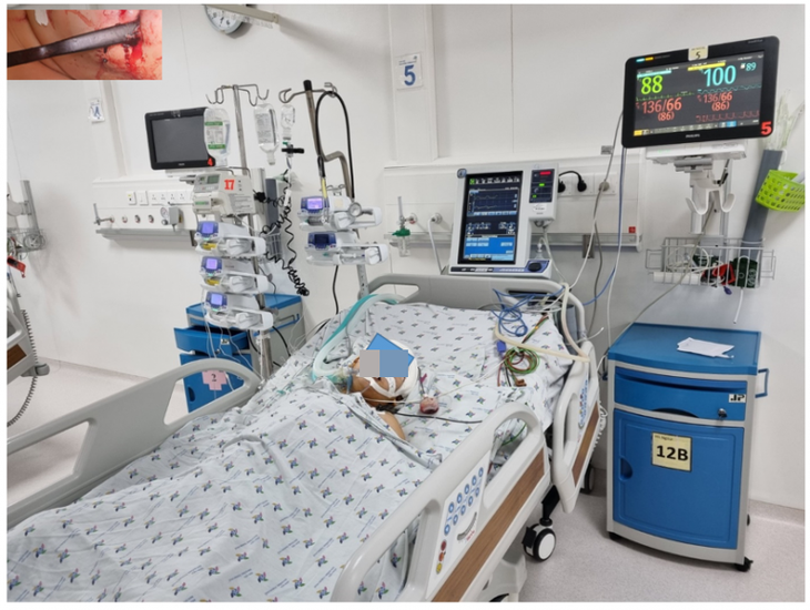 Bé gái bị tay thắng xe đạp cắm vào hốc mắt đã hồi phục kỳ diệu - Ảnh 1.