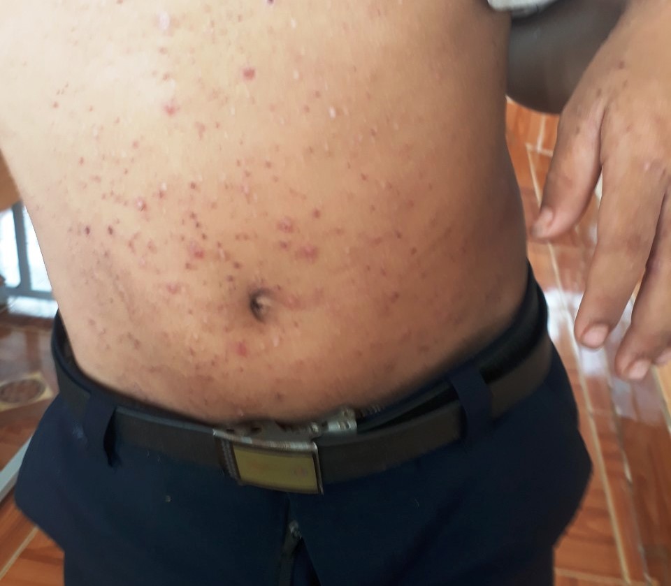 Quảng Ngãi: Thêm 1 xã có hàng trăm người mắc bệnh ghẻ - Ảnh 1. Quảng Ngãi: Thêm 1 xã có hàng trăm người mắc bệnh ghẻ - Ảnh 1.