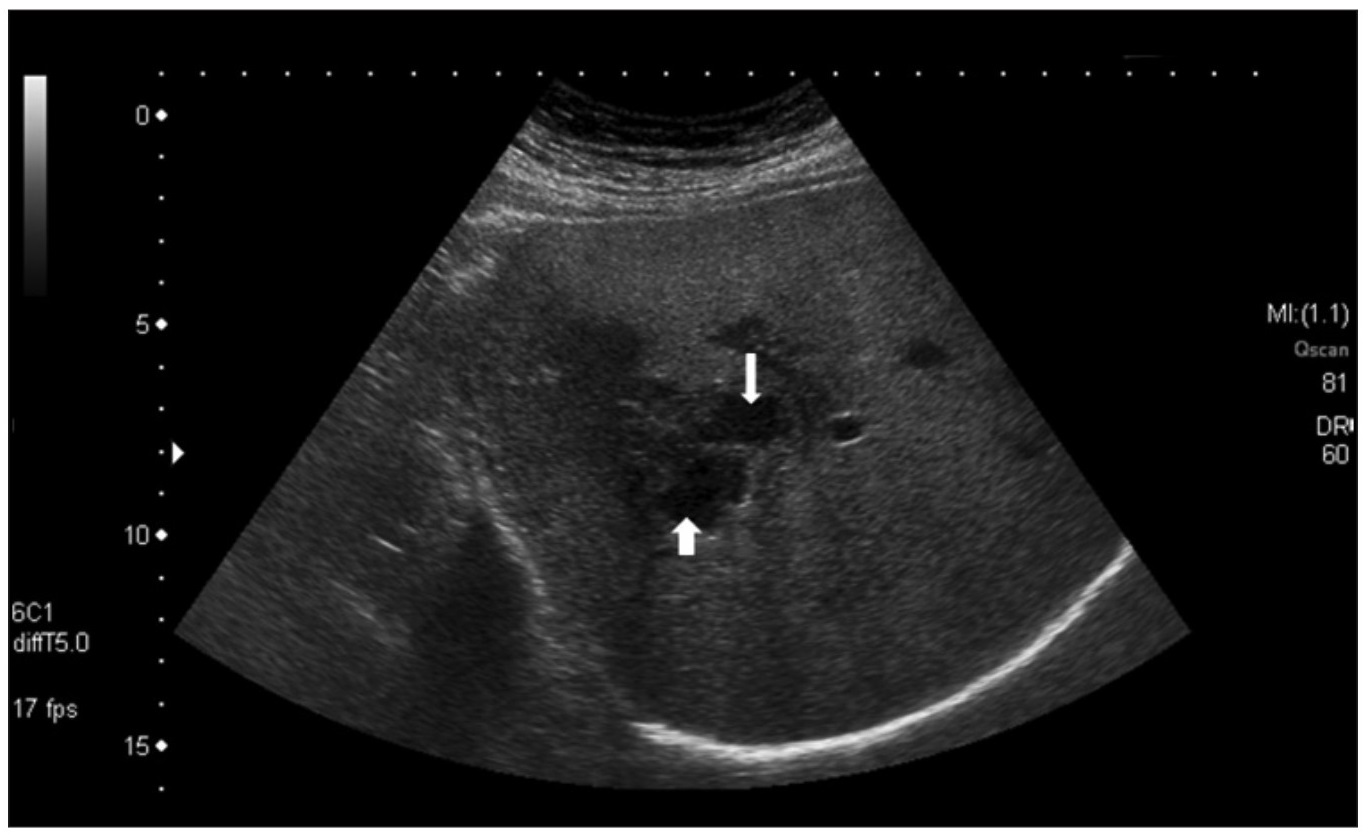 Áp Xe Gan Trên Siêu Âm: Chẩn Đoán và Điều Trị