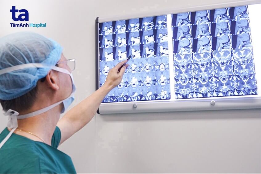 2 đường mổ cùng lúc lấy u lạ nhiều râu trong đầu - Ảnh 1. 2 đường mổ cùng lúc lấy u lạ nhiều râu trong đầu - Ảnh 1.