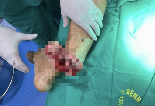 Bác sĩ xuyên đêm nối thành công bàn chân bị cưa máy cắt đứt lìa cho bệnh nhân 58 tuổi - Ảnh 1.
