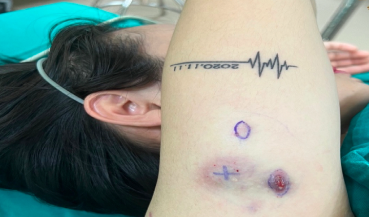 Tiêm tan mỡ giảm béo, cô gái trẻ nổi u cục khắp người - Ảnh 3. Tiêm tan mỡ giảm béo, cô gái trẻ nổi u cục khắp người - Ảnh 3.