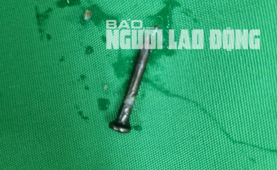 Bé trai gặp nguy hiểm khi nuốt cây đinh lúc đang chơi đùa - Ảnh 2. Bé trai gặp nguy hiểm khi nuốt cây đinh lúc đang chơi đùa - Ảnh 2.