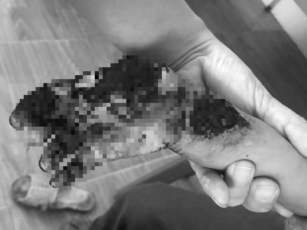 Cầm đầu dây sạc điện thoại, bé 3 tuổi bị giật cháy tay – SKCD