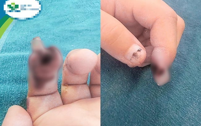 Bé trai 5 tuổi được gia đình đưa đi cấp cứu khi ngón tay vẫn dính chặt vào ổ khóa. - Ảnh 3.