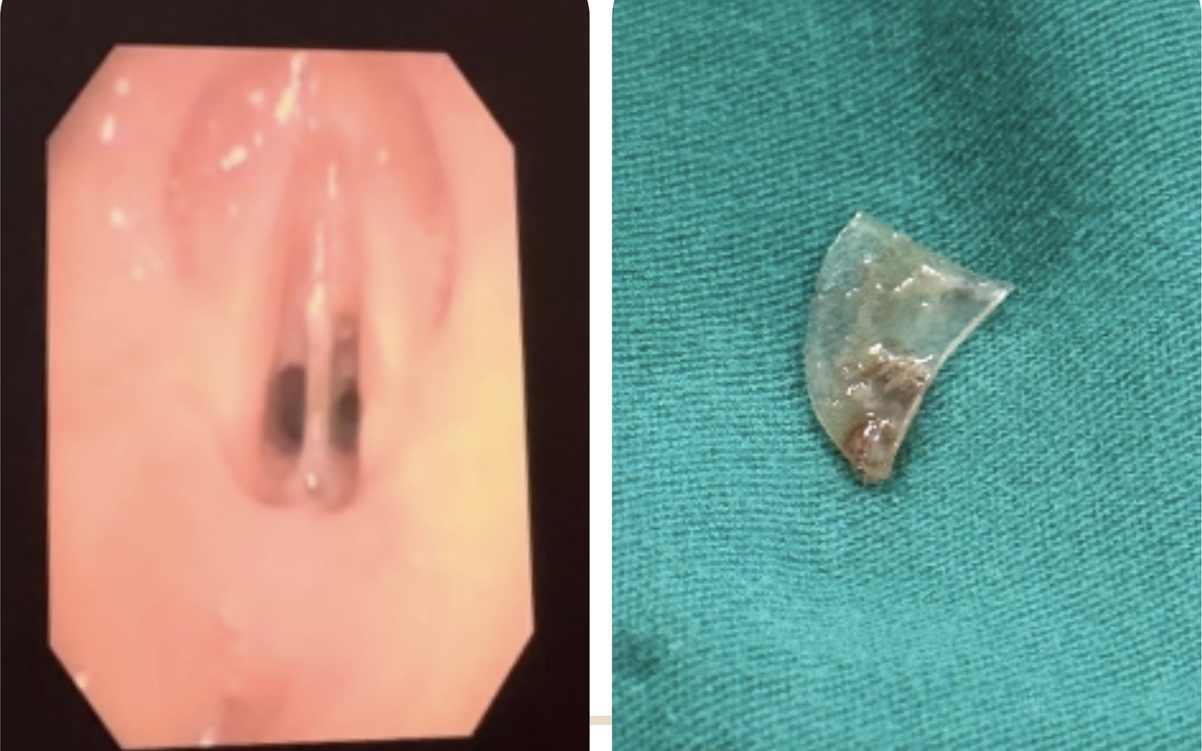 B&aacute;c sĩ "giật m&igrave;nh" khi thấy c&acirc;y b&uacute;t mắc kẹt trong b&agrave;ng quang thiếu nữ 16 tuổi  - Ảnh 2.