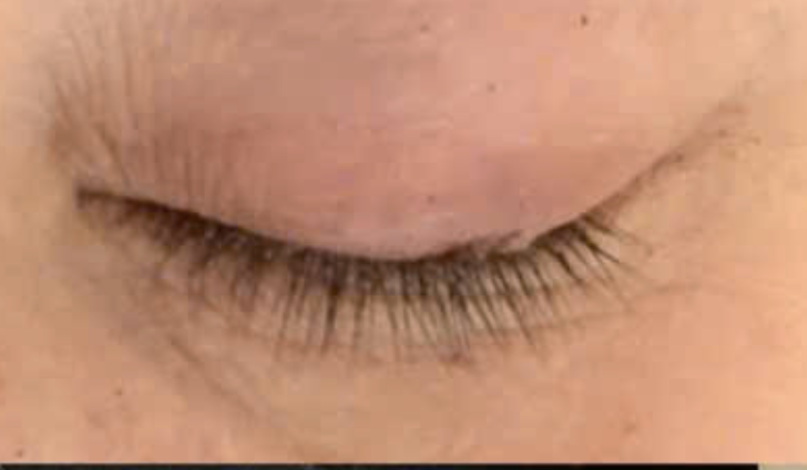 Gắp hàng chục con rận và trứng làm tổ ở mi mắt- Ảnh 2. Gắp hàng chục con rận và trứng làm tổ ở mi mắt- Ảnh 2.