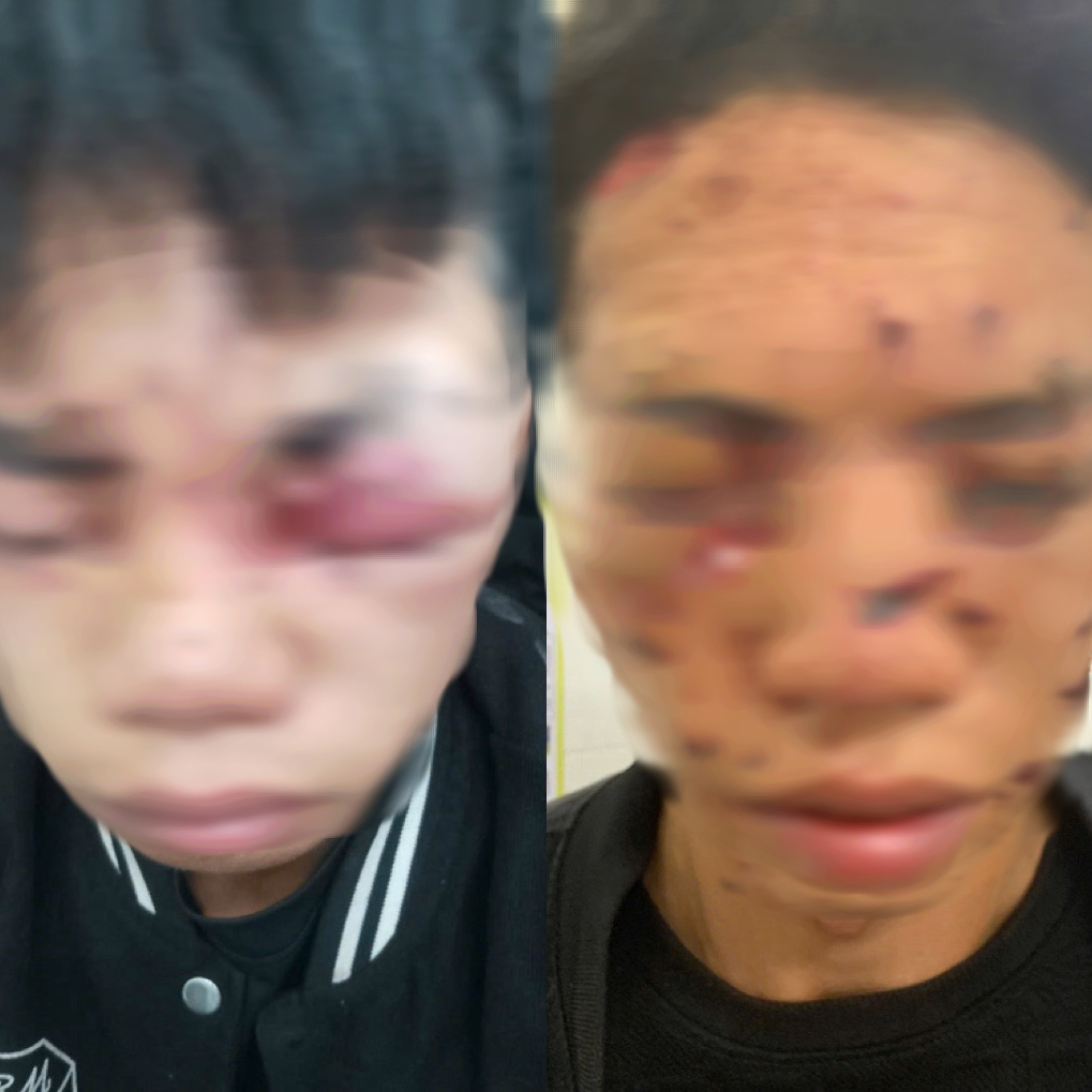 Mù mắt khi tự chế pháo- Ảnh 1. Mù mắt khi tự chế pháo- Ảnh 1.