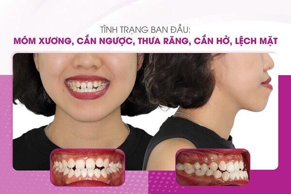 Móm xương nặng có niềng răng ở tuổi 26 được không?- Ảnh 2.