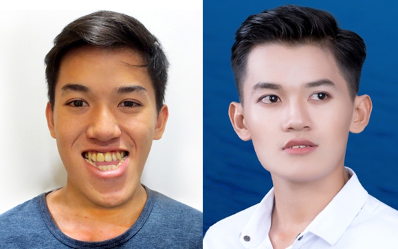 Tái tạo thành công vùng mông cho người bị ung thư trực tràng - Ảnh 2.
