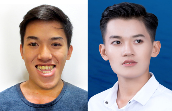 Anh Ca Trần Khánh Du “thay tướng, đổi vận” sau ca phẫu thuật thẩm mỹ Anh Ca Trần Khánh Du “thay tướng, đổi vận” sau ca phẫu thuật thẩm mỹ