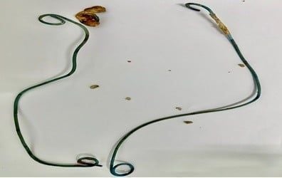 Cô gái 29 tuổi sống cùng dụng cụ y tế hơn hơn 1,5 năm - Ảnh 1.
