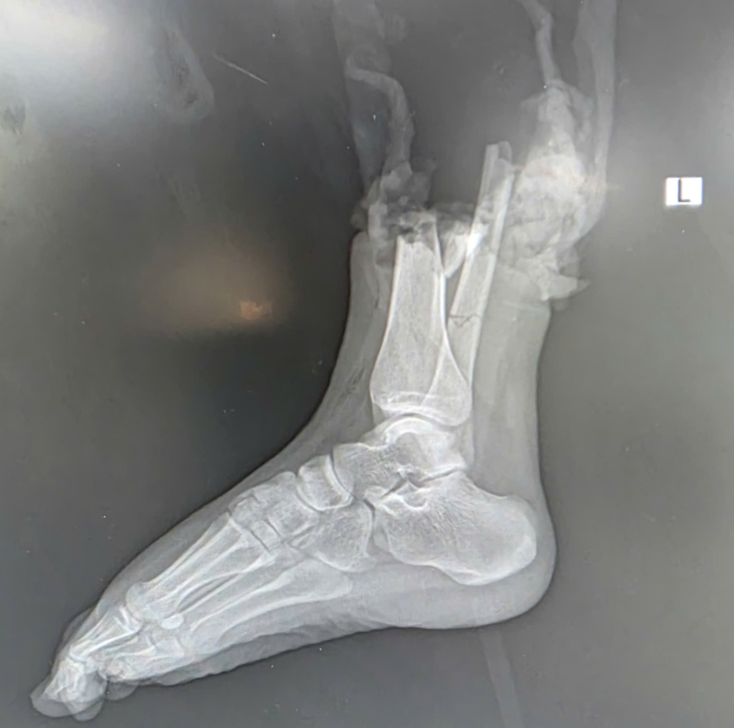 Nối chân bị đứt lìa cho cho cô gái va chạm với mô tô phân khối lớn - Ảnh 2.