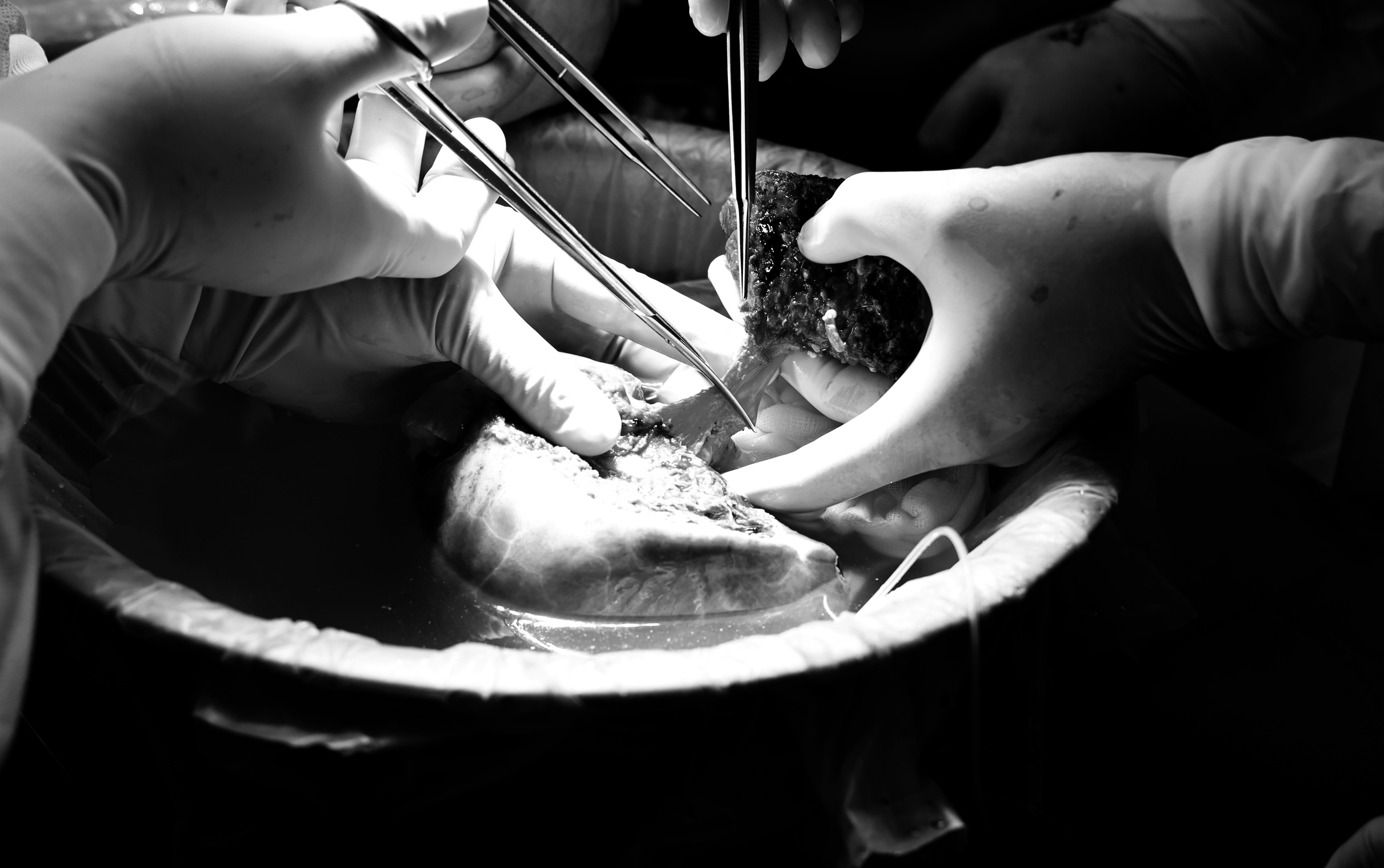 Chia lá gan trong ổ bụng, hồi sinh hai cuộc đời - Ảnh 1.