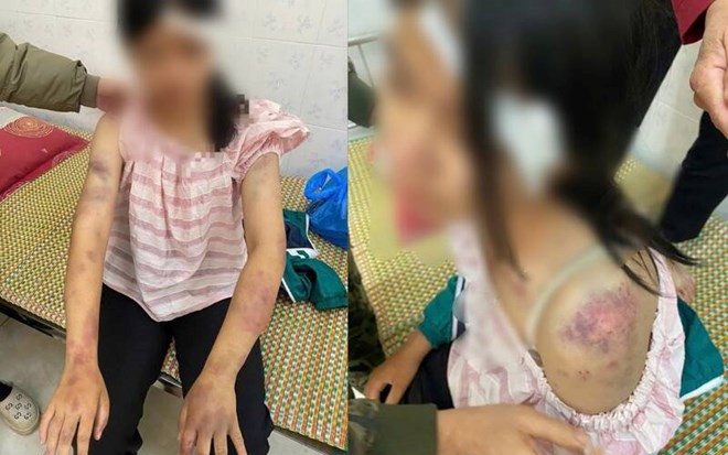 Thông tin mới vụ bé gái 13 tuổi bị tra khảo, đánh đập dã man, người chi chít vết thương - Ảnh 2.