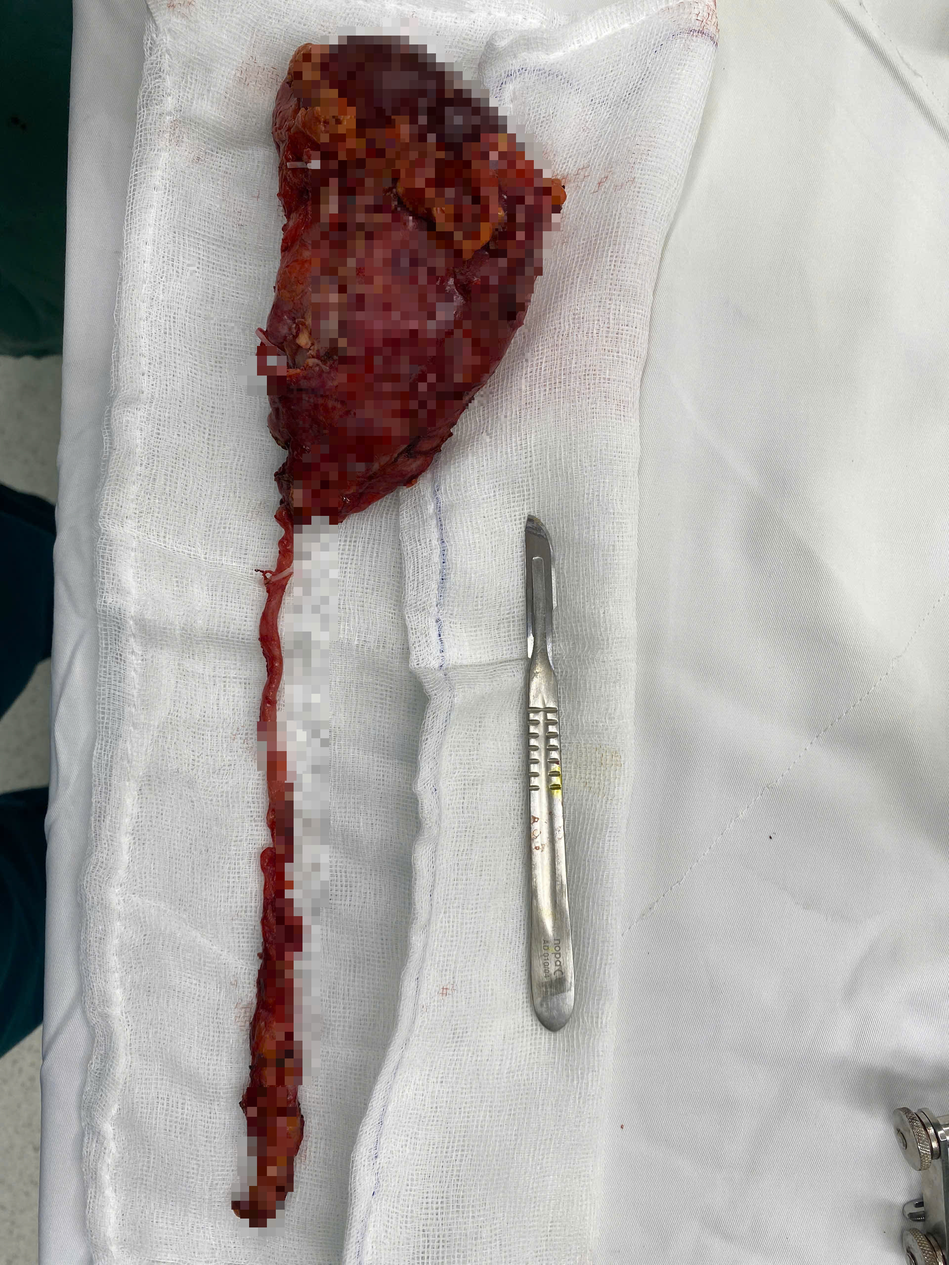 Đau lưng kéo dài, người đàn ông phát hiện 2 loại ung thư - Ảnh 2.