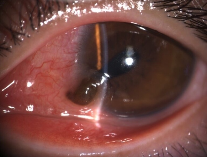 Thanh niên bị vật nhọn đâm vào nhãn cầu khi đang lao động - Ảnh 1.