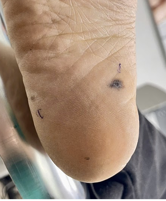 Đốm đen trên da, khi nào là dấu hiệu của ung thư da? - Ảnh 3.