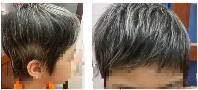 Bé gái 7 tuổi rụng hết tóc, bất ngờ mọc kín đầu sau một năm điều trị - Ảnh 3.