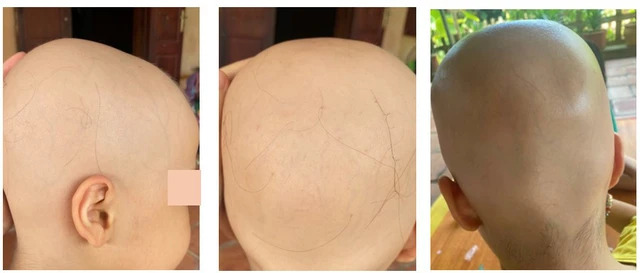 Bé gái 7 tuổi rụng hết tóc, bất ngờ mọc kín đầu sau một năm điều trị - Ảnh 1.