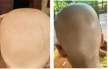 Bé gái 7 tuổi rụng hết tóc, bất ngờ mọc kín đầu sau một năm điều trị - Ảnh 2.