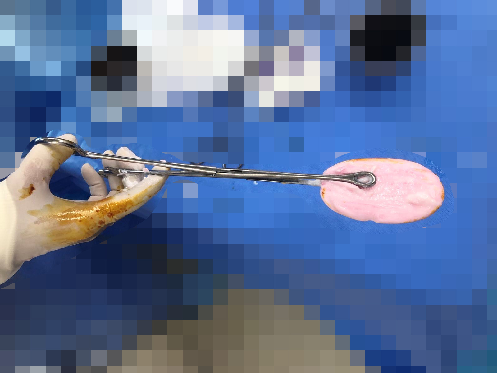 Sốc: Tò mò cơ thể , bé gái 12 tuổi nhét xà phòng vào âm đạo - Ảnh 1.