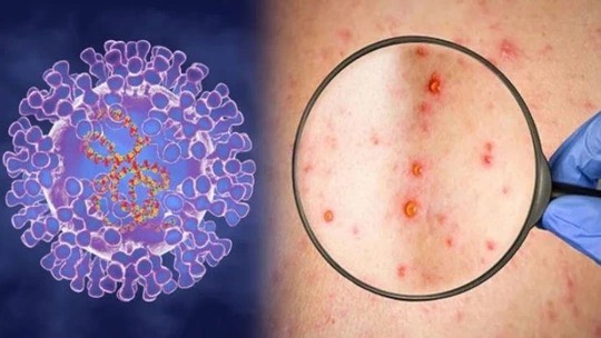 Phát hiện ca đậu mùa khỉ chưa rõ nguồn lây ở Đồng Nai - Ảnh 1.