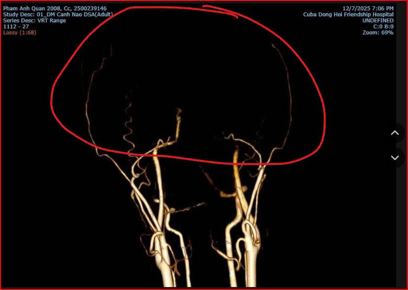 Bác sĩ bất ngờ lý giải nguyên nhân tử vong của thiếu niên xô xát ở quán bida Ba Đồn - Ảnh 1. Bác sĩ bất ngờ lý giải nguyên nhân tử vong của thiếu niên xô xát ở quán bida Ba Đồn - Ảnh 1.