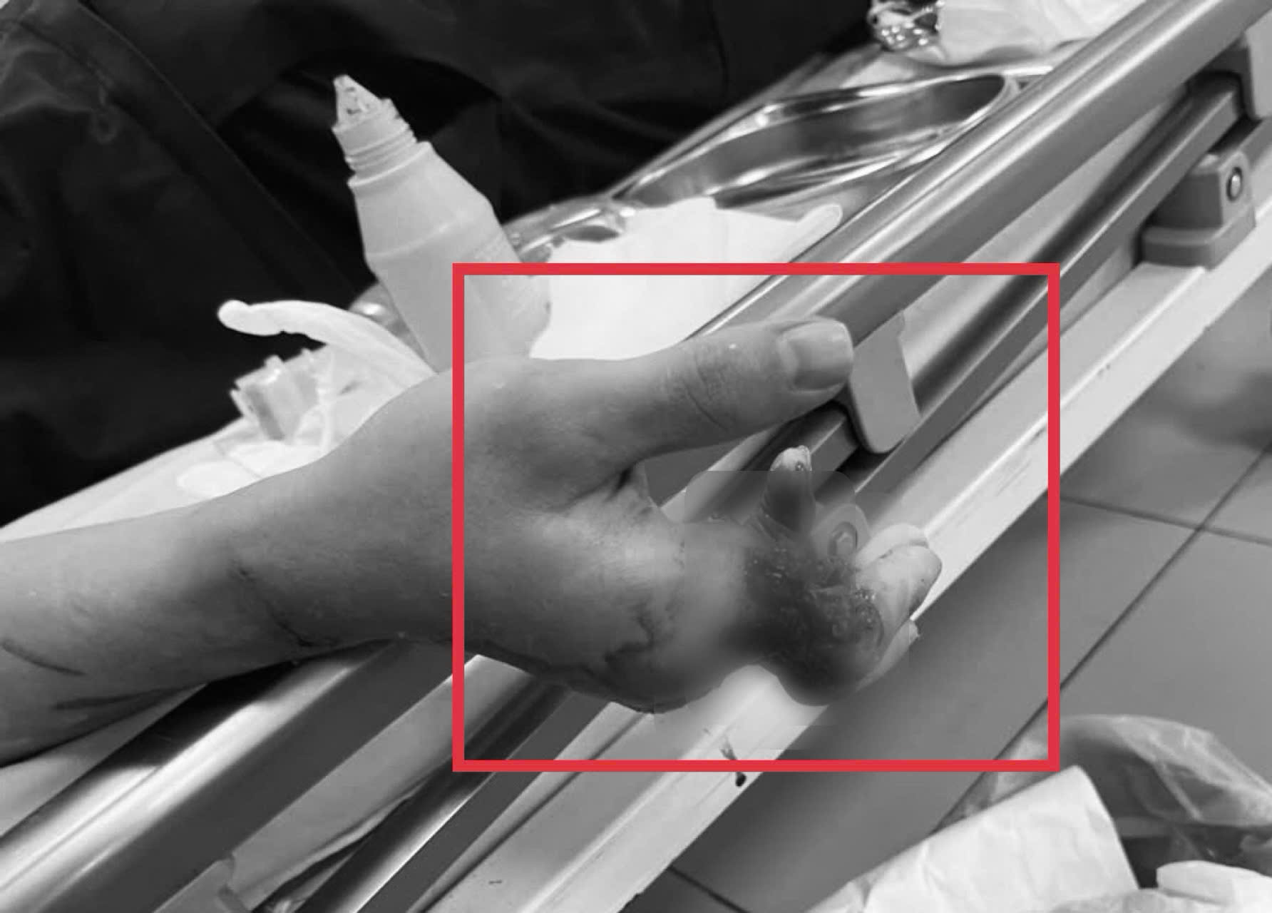 Cứu 4 ngón tay gần đứt rời cho thanh niên trẻ - Ảnh 1.