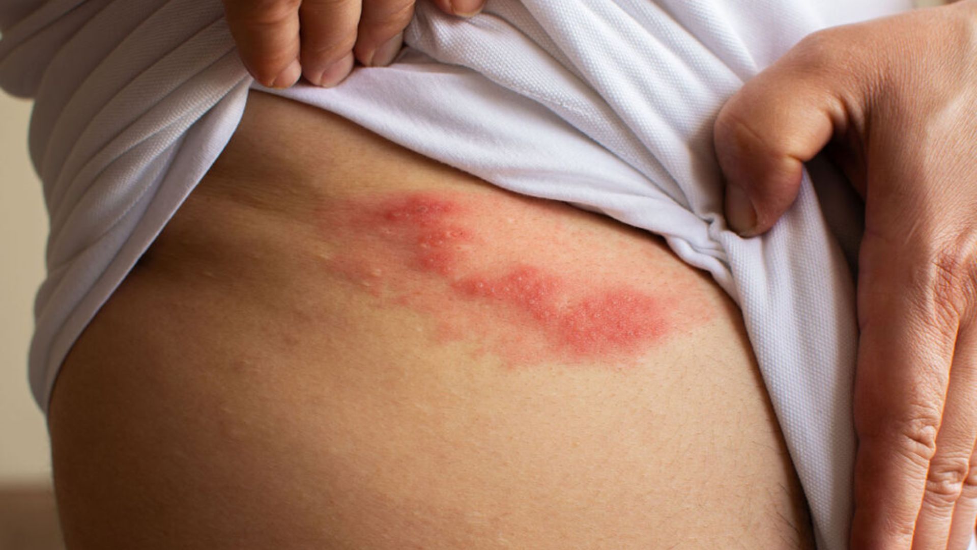 &ldquo;Giời leo&rdquo; kh&ocirc;ng đ&aacute;ng sợ, đ&aacute;ng sợ l&agrave; cơn đau dai dẳng sau khỏi bệnh - Ảnh 1.