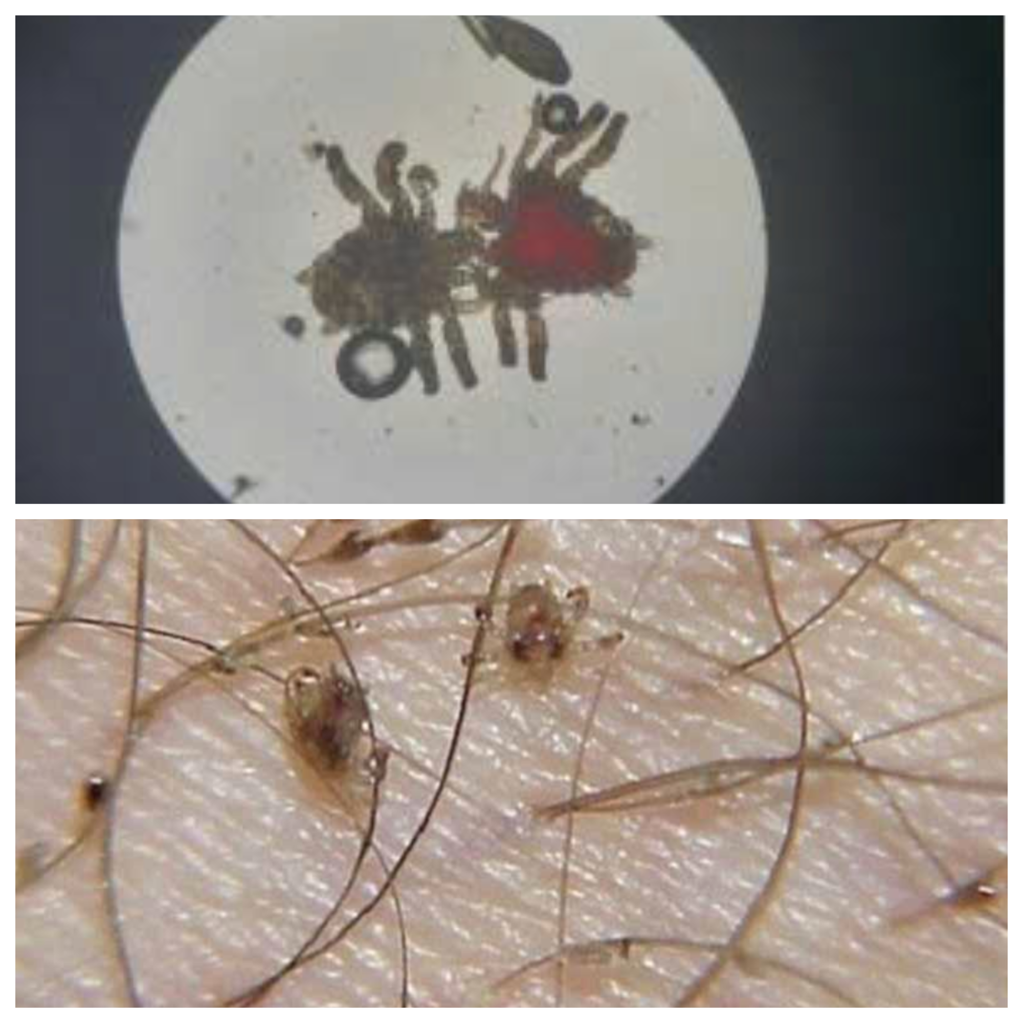 Ngứa dữ dội “vùng kín”, người đàn ông tá hỏa khi phát hiện rận mu kí sinh - Ảnh 1.