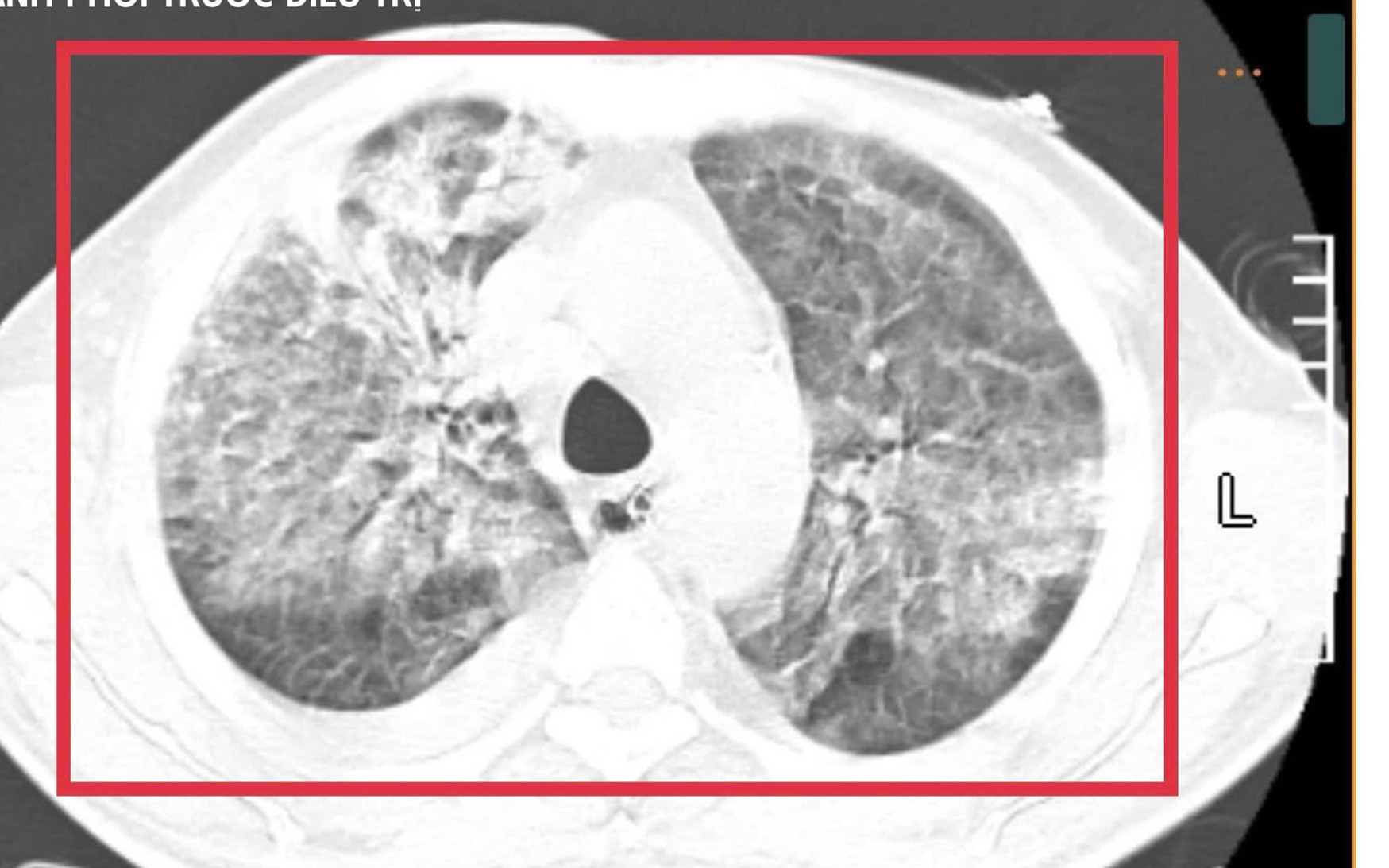 Bệnh vi khuẩn "ăn thịt người" thực chất l&agrave; g&igrave;? - Ảnh 2.