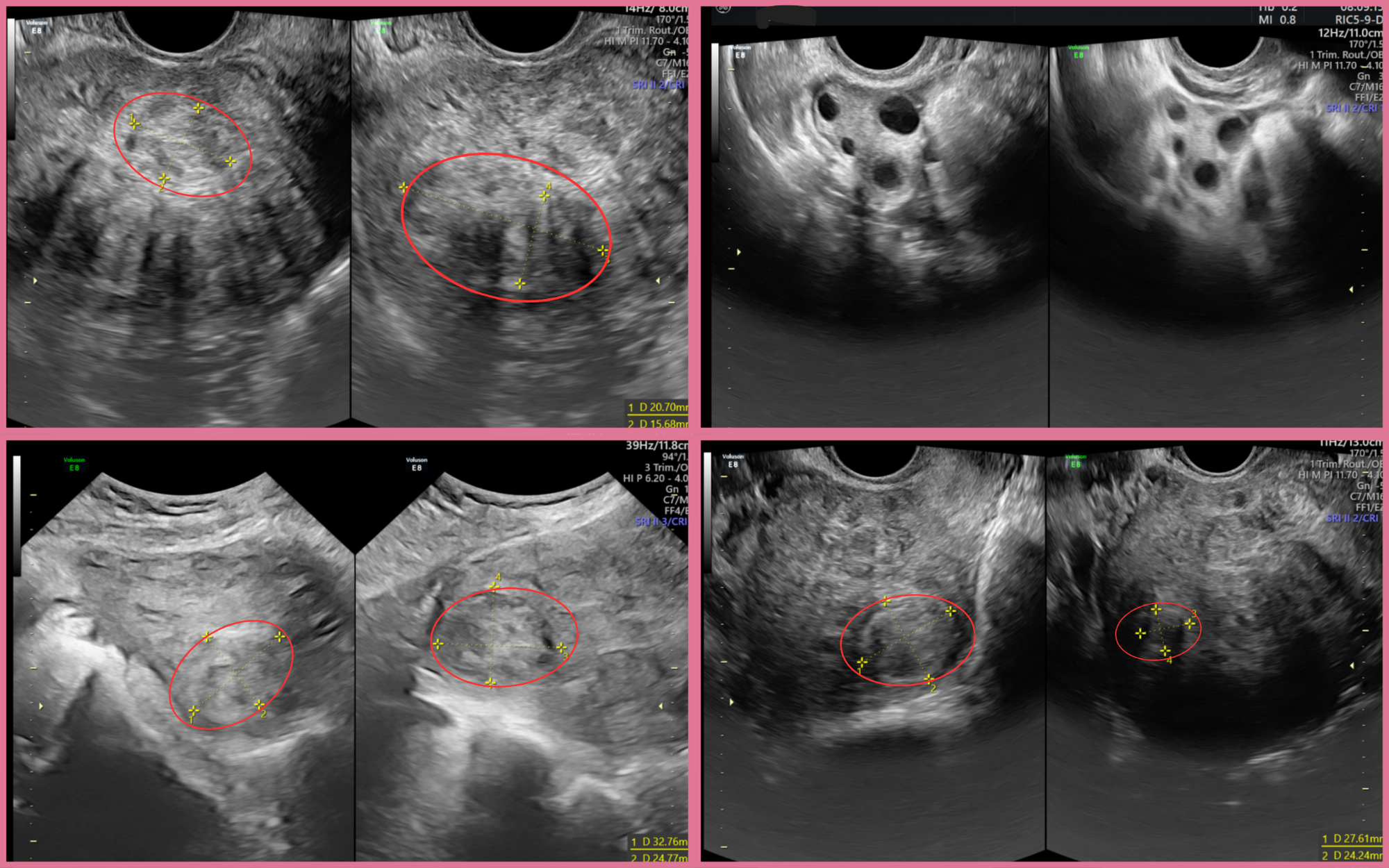 Bóc 18 khối u xơ, bảo toàn tử cung cho bệnh nhân - Ảnh 1.