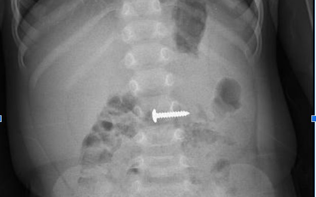 B&eacute; 2 tuổi ở Gia Lai nhập viện v&igrave; nuốt nhầm dầu thơm - Ảnh 2.