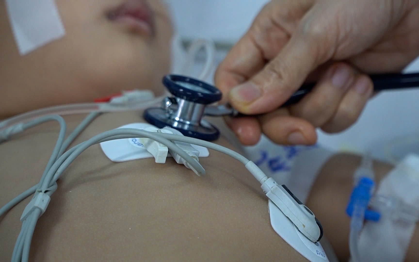 Bé trai 2 tuổi nguy kịch vì bệnh tay chân miệng sau 2 ngày phát bệnh - Ảnh 2.