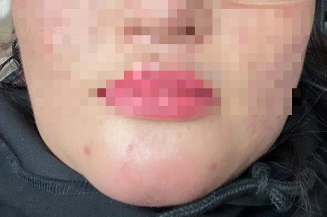 Người đàn ông mù mắt sau tiêm filler xóa nhăn "thế hệ mới"- Ảnh 2. Người đàn ông mù mắt sau tiêm filler xóa nhăn "thế hệ mới"- Ảnh 2.
