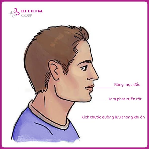 Trẻ thở bằng miệng khi ngủ? Đừng bỏ qua dấu hiệu khiến xương hàm phát triển lệch lạc- Ảnh 1.