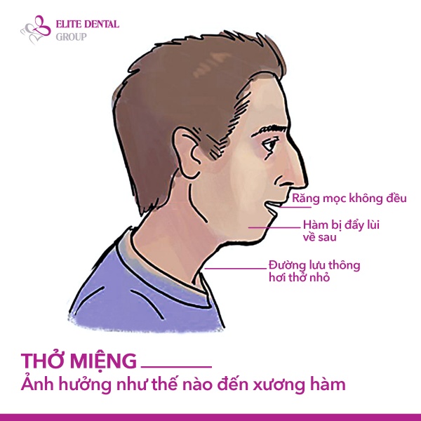 Trẻ thở bằng miệng khi ngủ? Đừng bỏ qua dấu hiệu khiến xương hàm phát triển lệch lạc- Ảnh 2.