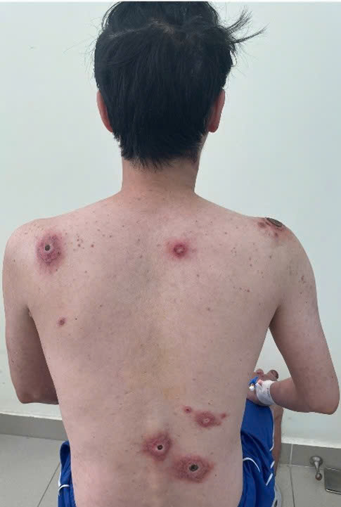 Vết loét tự lành – Dấu hiệu ban đầu của căn bệnh tình dục chết người- Ảnh 1.