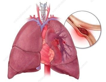 Suýt chết vì dùng thuốc tránh thai suốt 10 năm- Ảnh 1.