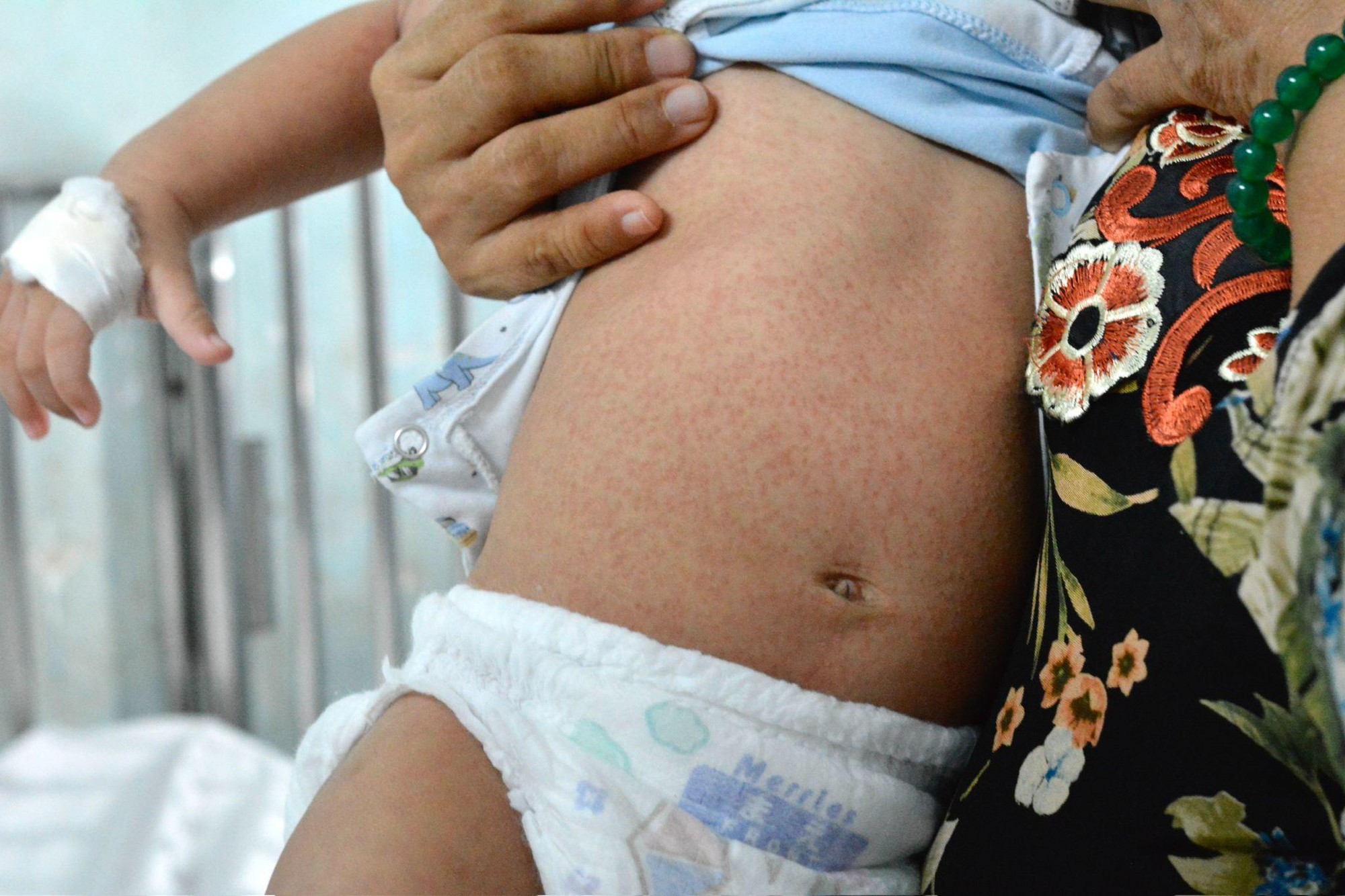 Việt Nam lần đầu có vắc-xin phối hợp phòng 4 bệnh sởi, quai bị, rubella và thủy đậu- Ảnh 2.