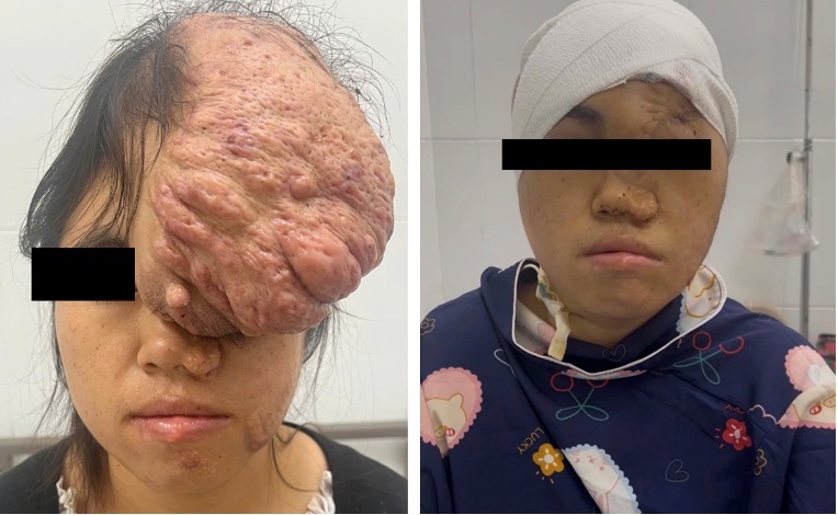 Khối u khổng lồ trên mặt khiến cô gái sống ẩn mình 15 năm - Ảnh 1.